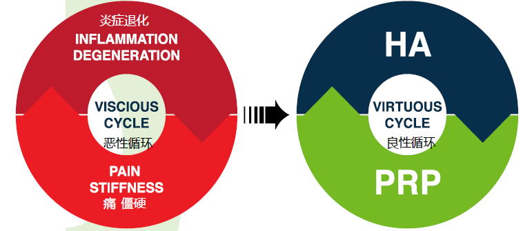 透明质酸+PRP联合疗法可以打破骨关节炎的恶性循环.png