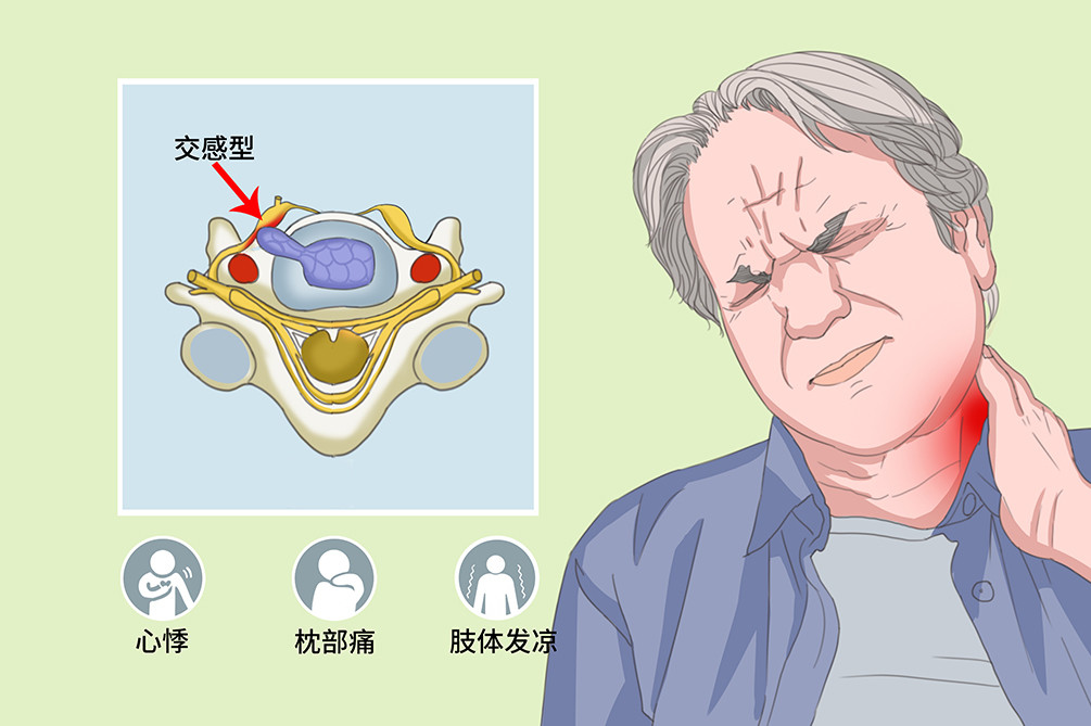 交感神经型颈椎病