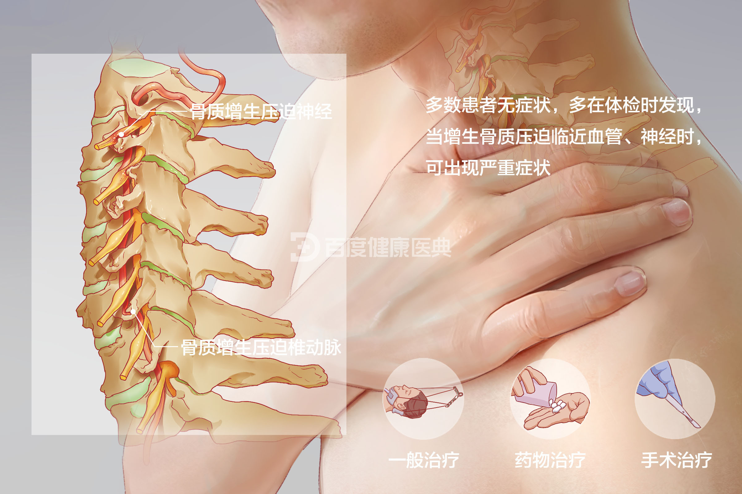 颈椎骨质增生