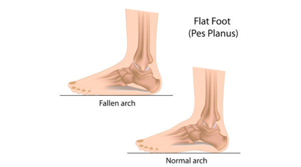 扁平足造成4大危害不可轻视！