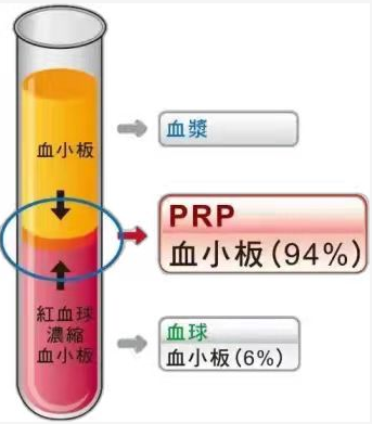 PRP治疗——骨性关节炎新技术带来新“膝”望！