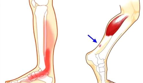 得了肌腱炎怎么办，PRP疗法可以治疗肌腱炎吗？