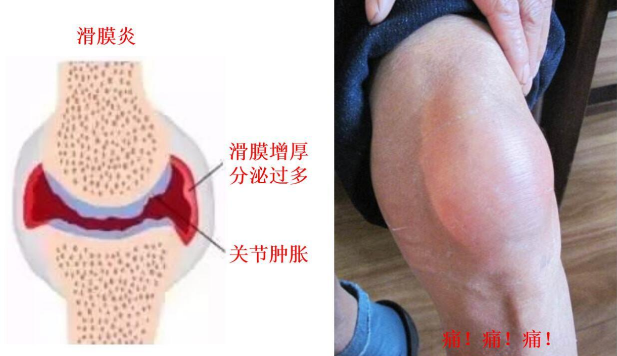 无法行走的痛，踝关节滑膜炎是怎么来的？PRP可以治疗滑膜炎吗？