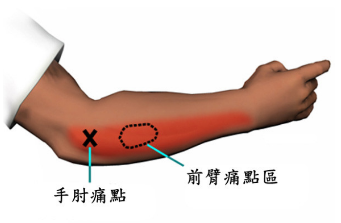 网球肘怎么治疗才能好？PRP新疗法缓解疼痛