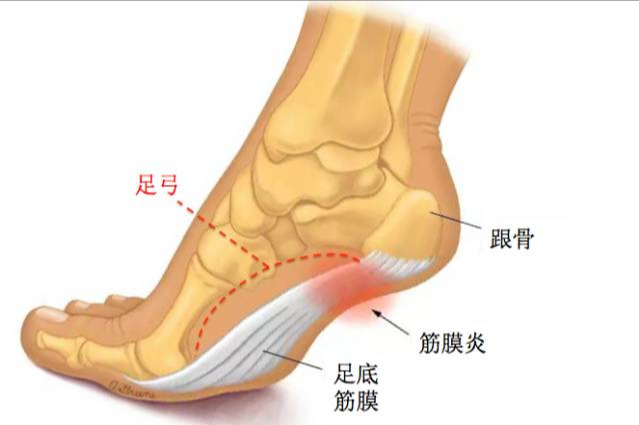 得了足底筋膜炎怎么办？新疗法PRP缓解足跟痛疼