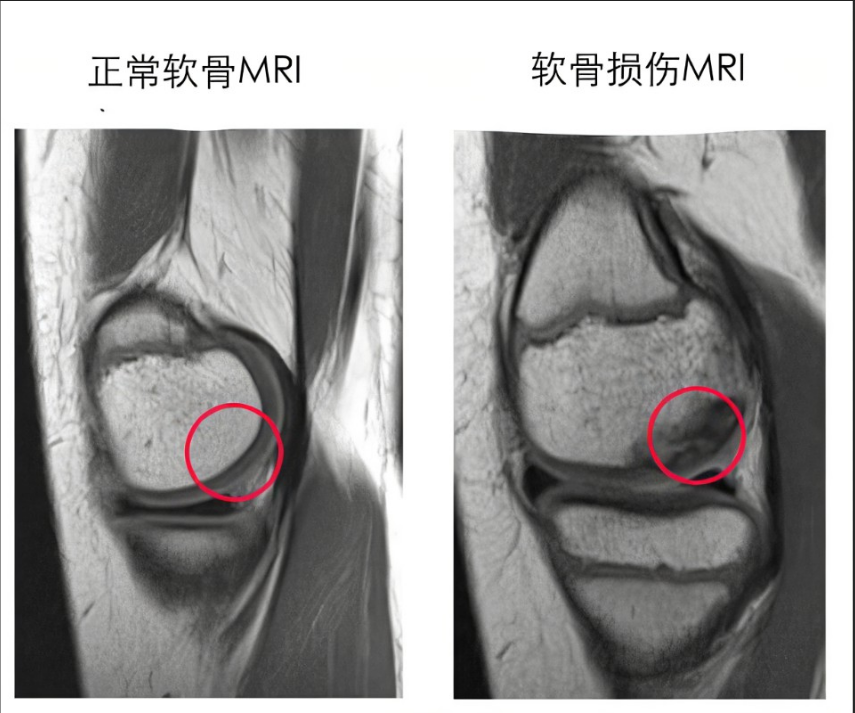 为什么会膝关节软骨损伤？可以打PRP吗？