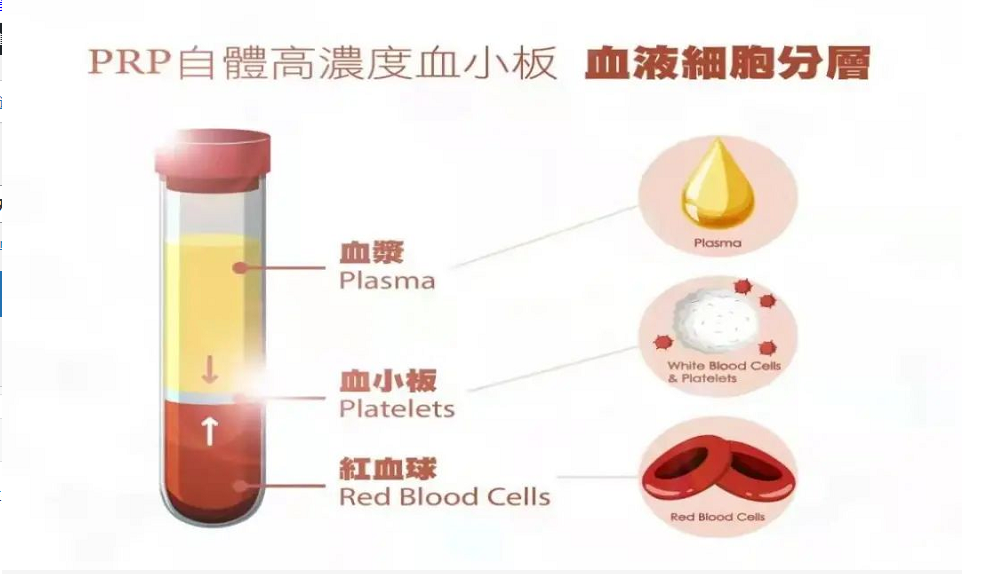 PRP - 富血小板血浆有效治疗骨关节疾病 