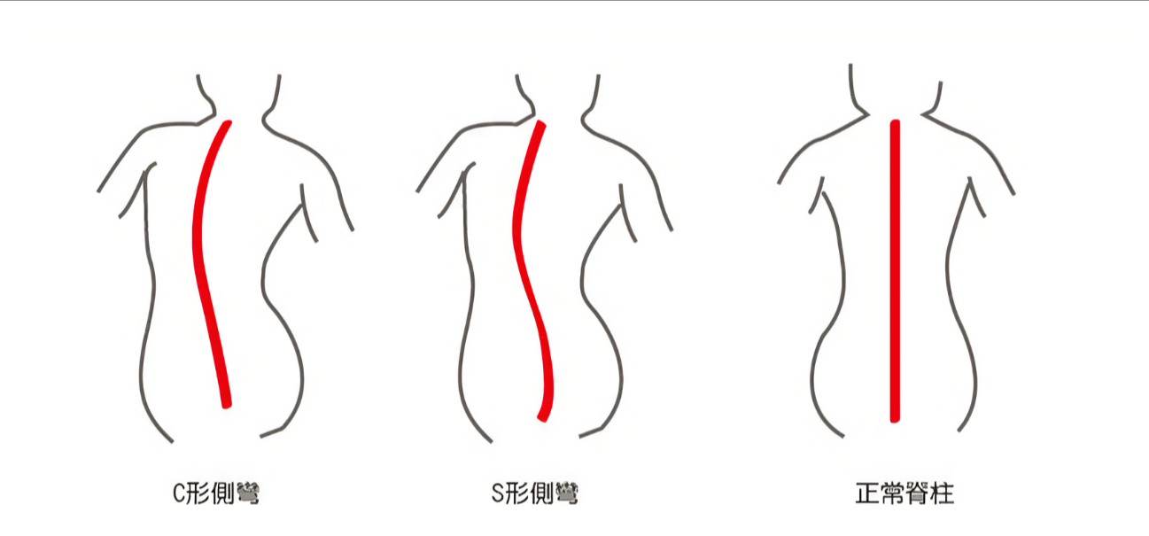 惠州骨科专家提醒：脊柱侧弯是怎样的？脊柱侧弯有哪些危害？