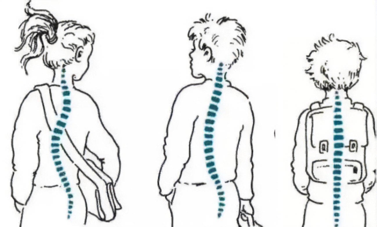 如何在早期发现脊柱侧弯？早期症状是什么？—惠州凯斯骨科
