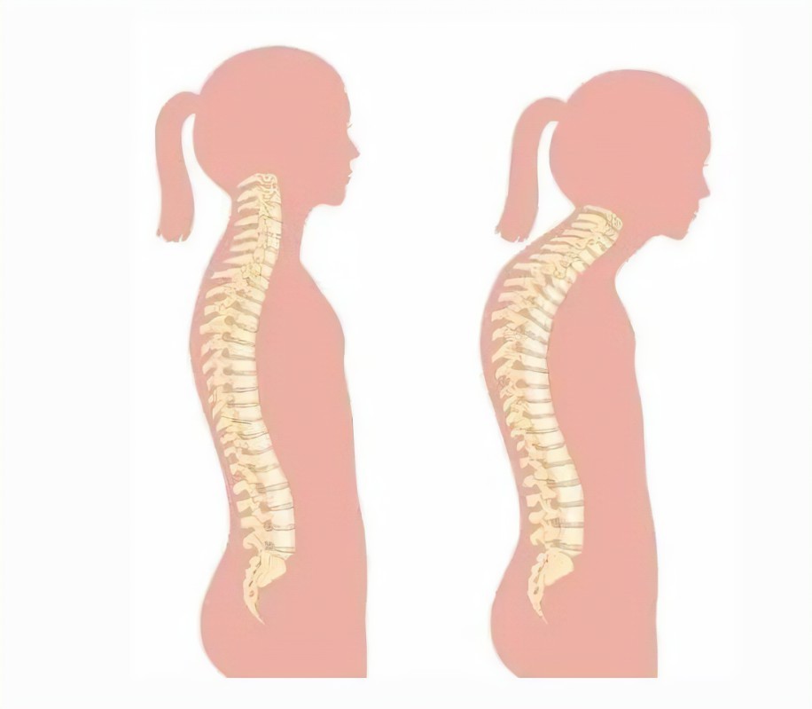 惠州骨科专家提醒：患了脊柱侧弯有哪些注意事项，记住这五点