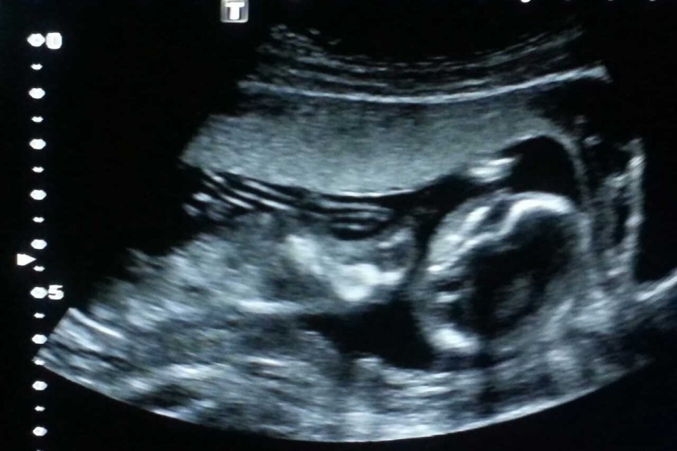 胎儿时期能否通过产检发现脊柱侧弯吗？有脊柱侧弯可以生下来吗？