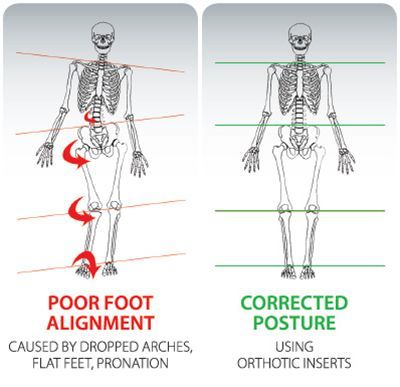 【脊柱侧弯康复案例】扁平足与脊柱侧弯有关？