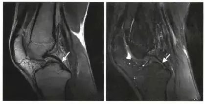 【典型病历】PRP疗法修复胫侧副韧带损伤