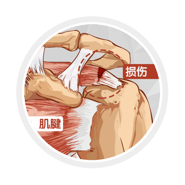 【精品科普】肩痛常病因  及专家推荐治疗方案（下）