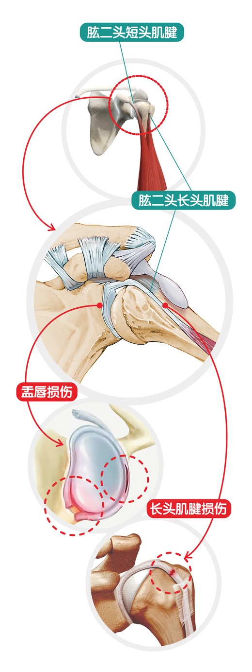 【精品科普】肩痛常病因  及专家推荐治疗方案（下）