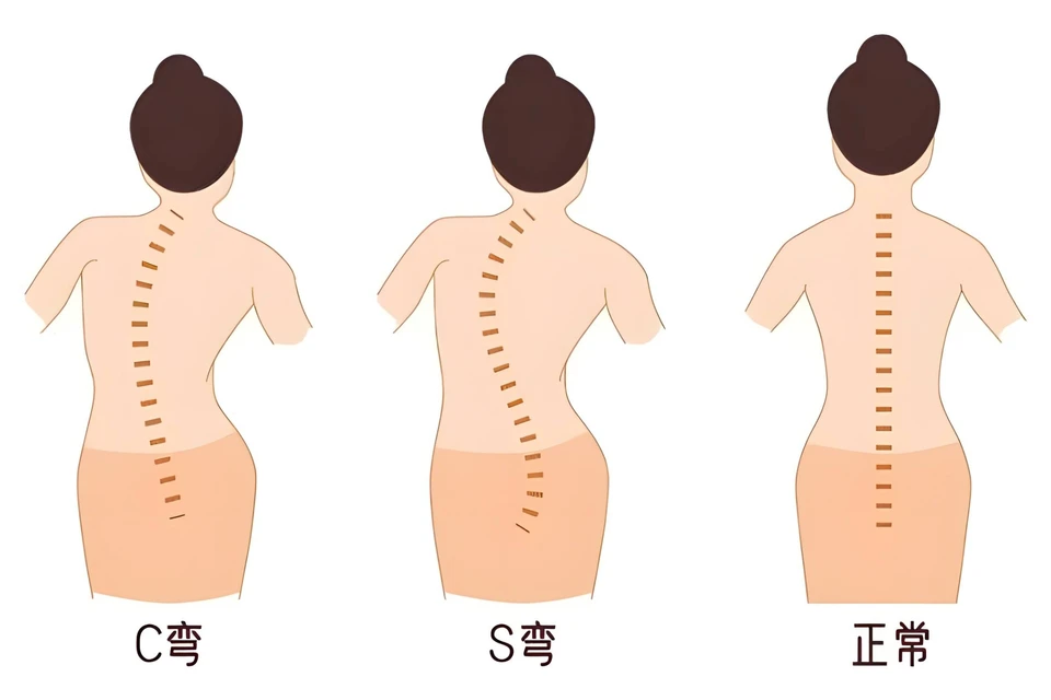 惠州凯斯骨科：青少年脊柱侧弯有什么表现？有什么影响？